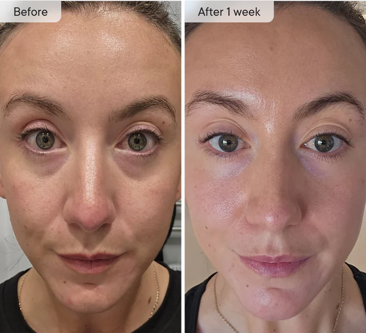 Micro-Infusion Targeted Patches